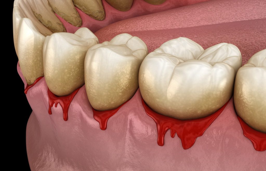 3D image of bleeding gums gum disease dentists in Lansdale Pennsylvania