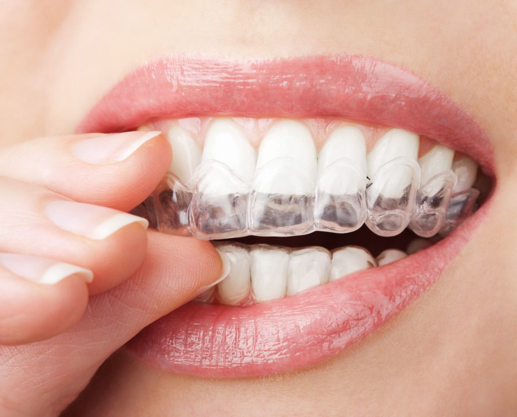 Closeup image of patient putting their clear Invisalign aligners in their mouth cosmetic dentistry dentists in Lansdale Pennsylvania 