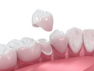 CEREC Same-Day Crowns: Skip The Temporary in Lansdale, PA