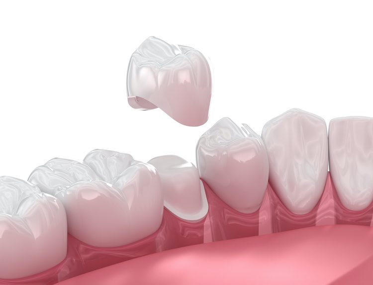 A dental crown, when properly cared for, can last many years, providing both aesthetic and functional benefits.