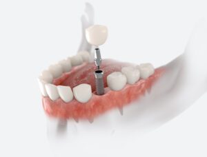 Dental Implants: What To Expect in Lansdale, PA